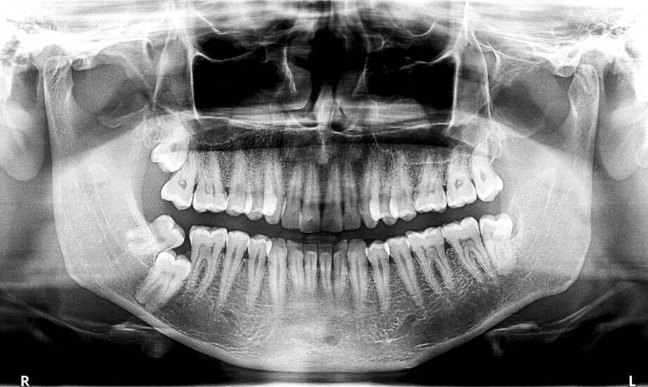 Pantomogram jako przegląd całej jamy ustnej — które zmiany widać od razu