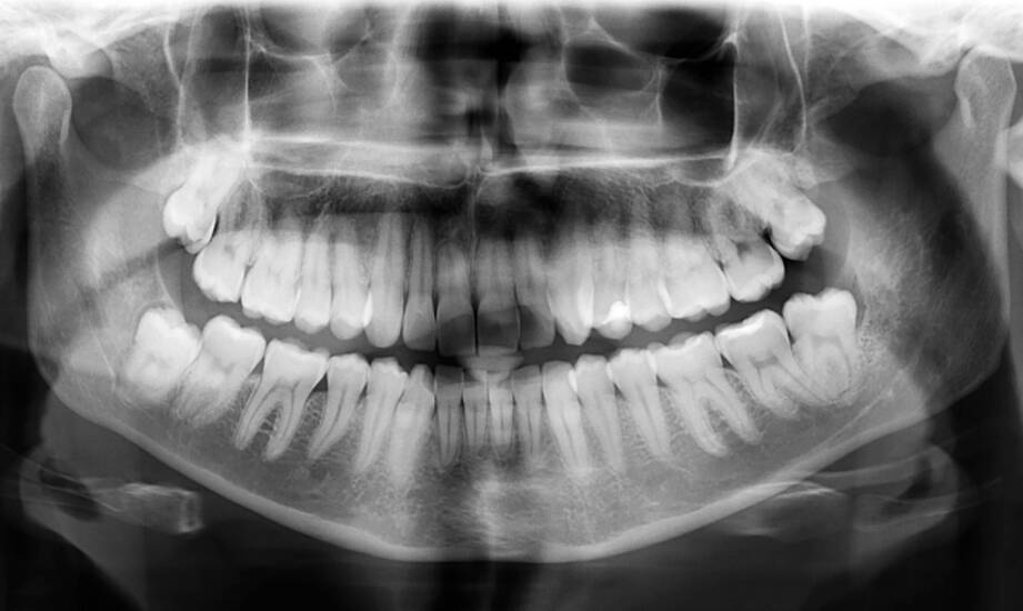 Co dentysta widzi na panoramie zębów i kiedy potrzebuje dokładniejszego obrazu