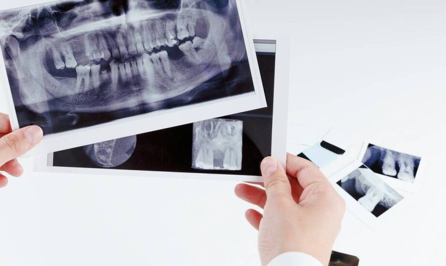 Zdjęcie rtg zęba a diagnostyka problemów z korzeniami – co warto wiedzieć?