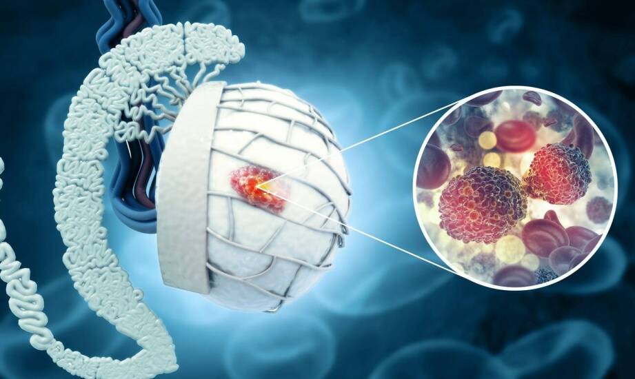 Jakie objawy neurologiczne mogą towarzyszyć oponiakom mózgu?