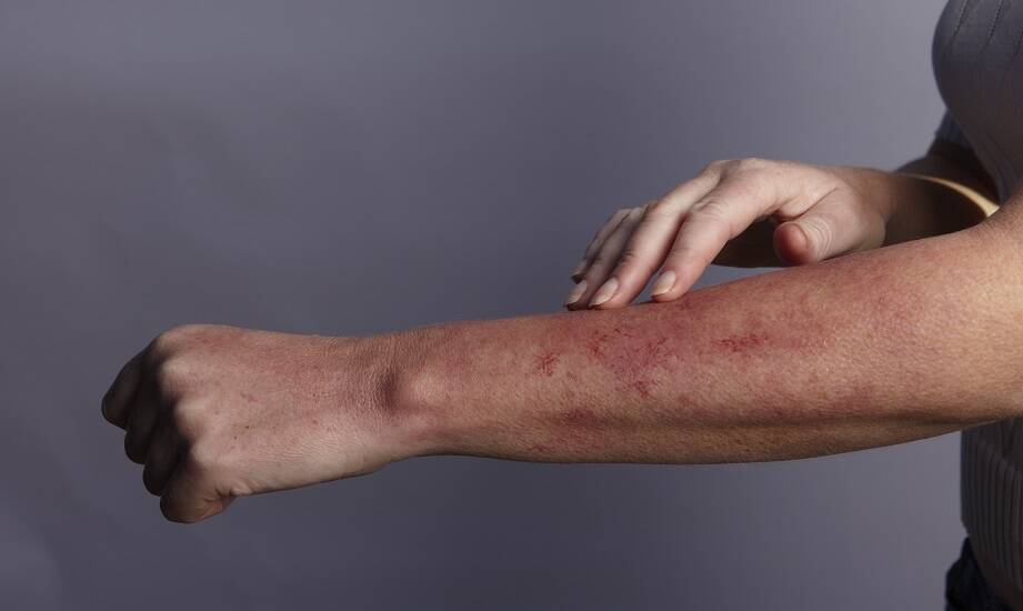 Jakie terapie oferuje dermatolog dla pacjentów z egzemą?