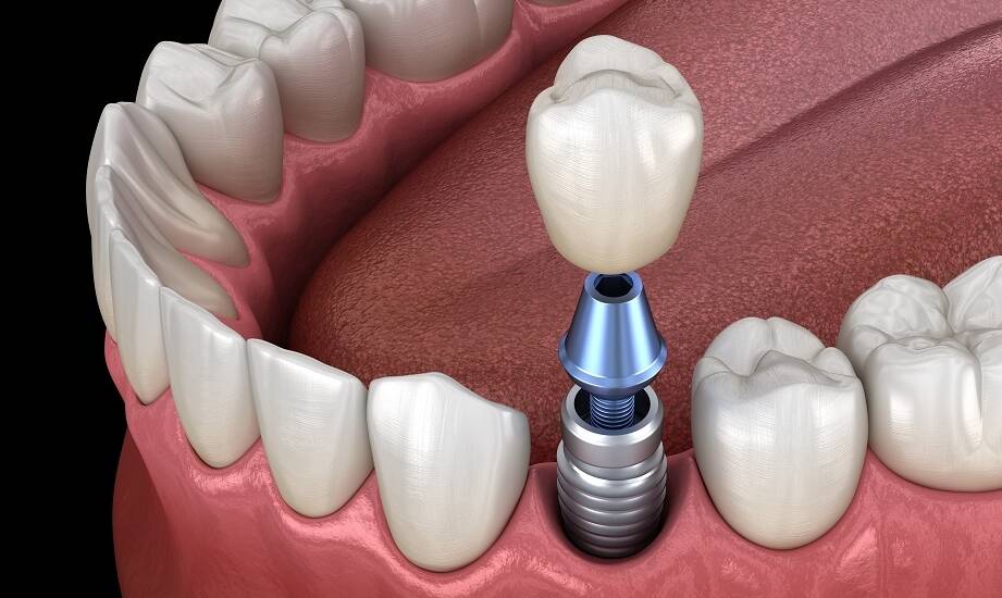 Jakie są najnowsze trendy w stomatologii estetycznej związane z implantami?