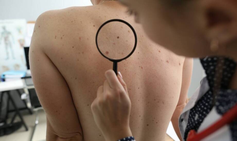 Znaczenie regularnych kontroli znamion u dermatologa