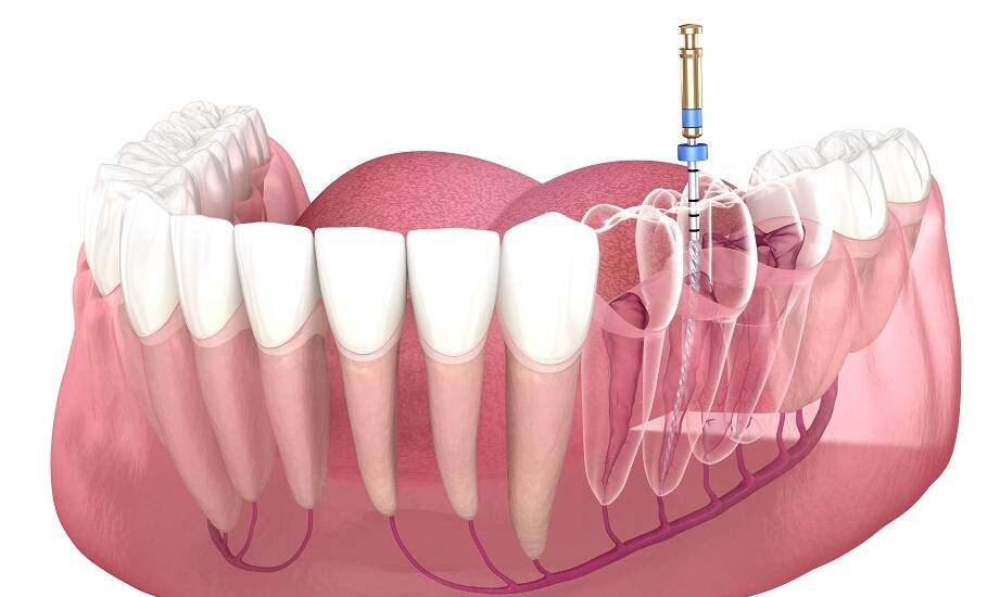 Jak dentysta dobiera odpowiednie leczenie endodontyczne?