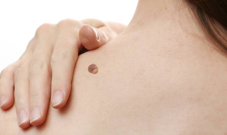 Czy brodawki na powiece mogą wskazywać na inne schorzenia?