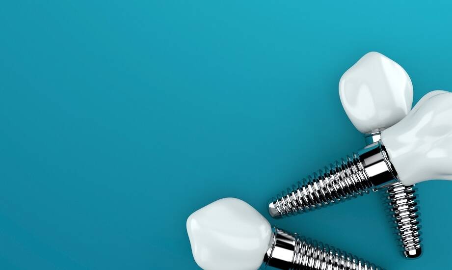 Jakie są etapy zakładania implantów stomatologicznych?