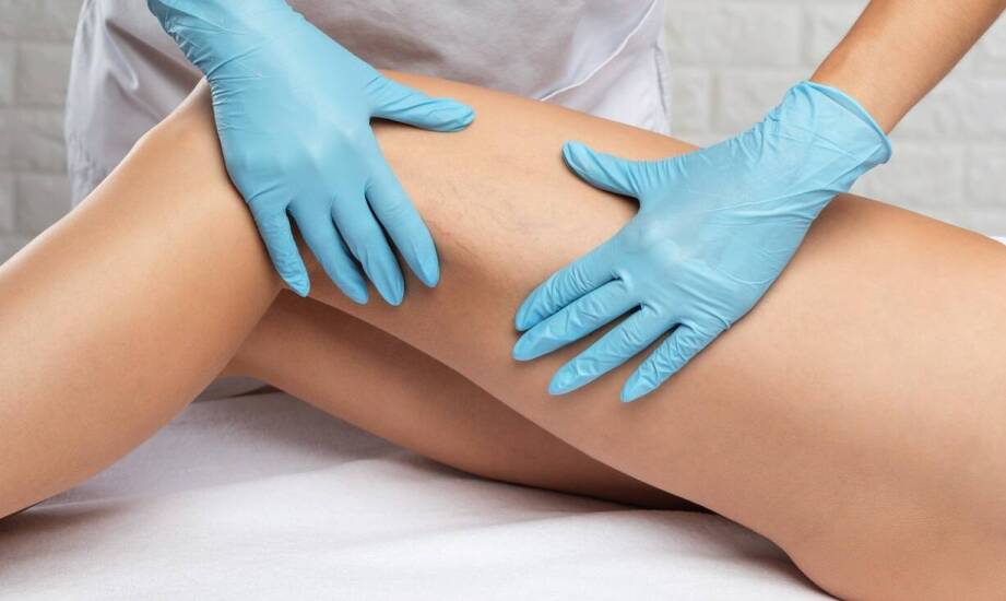 Co jest skuteczniejsze na pajączki - skleroterapia czy laser?