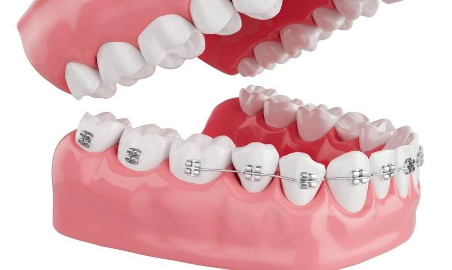 Jakie są długoterminowe efekty stosowania aparatów samoligaturujących?