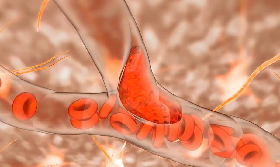 Jakie są alternatywy dla tradycyjnych leków na żylaki kończyn dolnych?