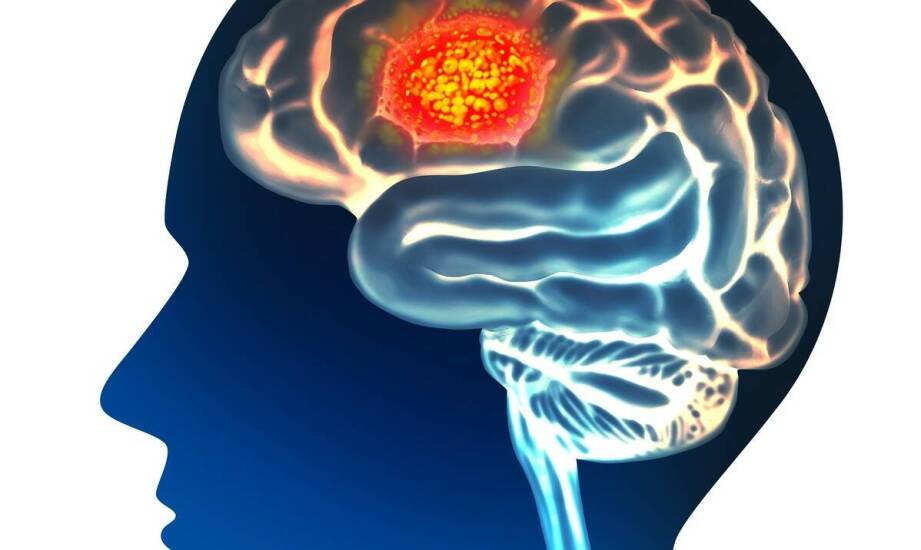 Torbiel Rathkego a zaburzenia hormonalne – co warto monitorować?