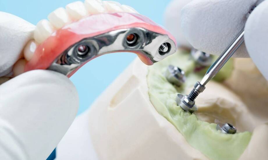 Implanty a zdrowie jamy ustnej – jakie są długoterminowe korzyści?