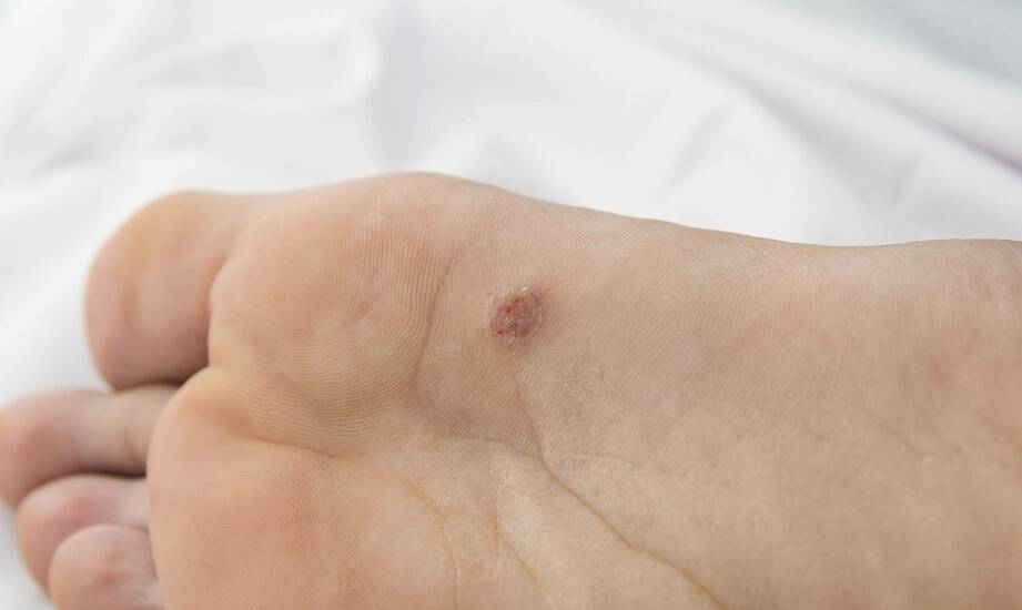 Diagnoza i terapia brodawek stóp - jak działa specjalista?