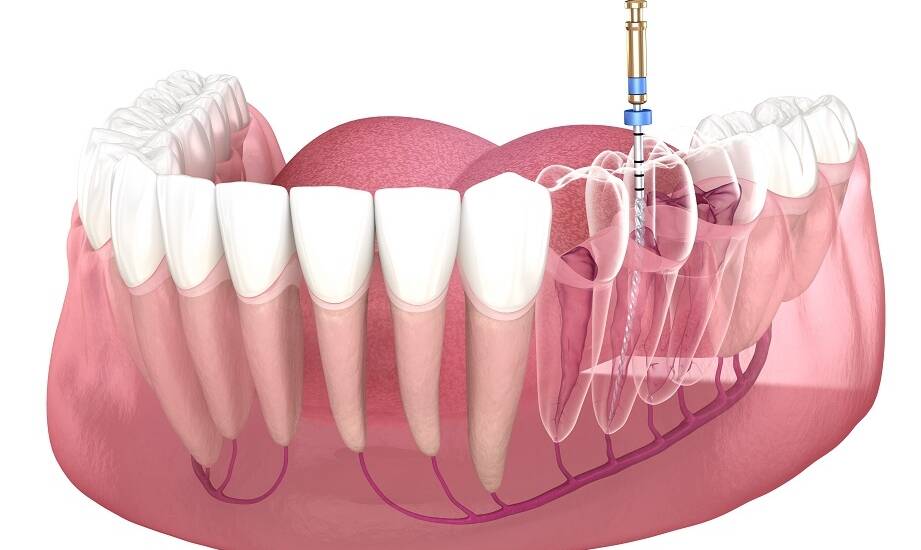 Endodoncja pod mikroskopem: jak technologia zmienia skuteczność leczenia kanałowego