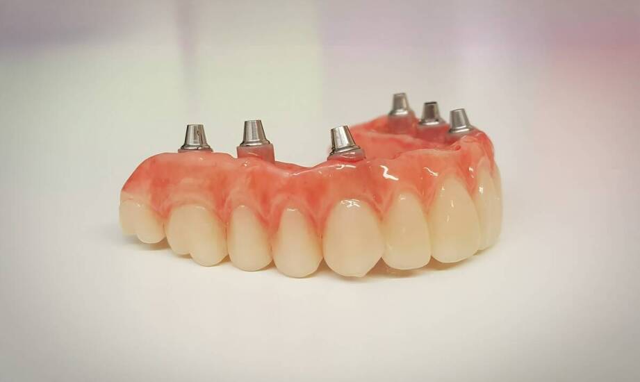 Dlaczego warto zainwestować w implanty zębowe? Kluczowe korzyści