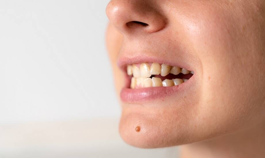 Jakie są rodzaje wad zgryzu?