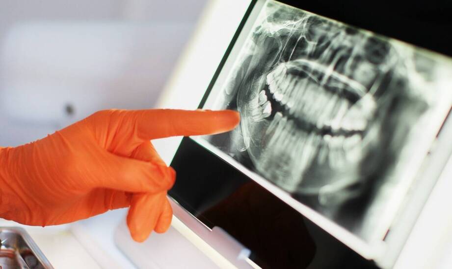 Co to jest rewizja leczenia kanałowego i kiedy jest potrzebna?