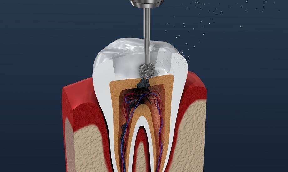 Jakie są najczęstsze problemy rozwiązywane przez leczenie kanałowe?