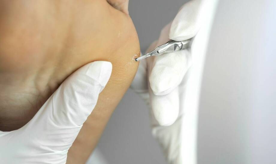 Usuwanie brodawek wirusowych w gabinecie podologicznym – na czym polega?