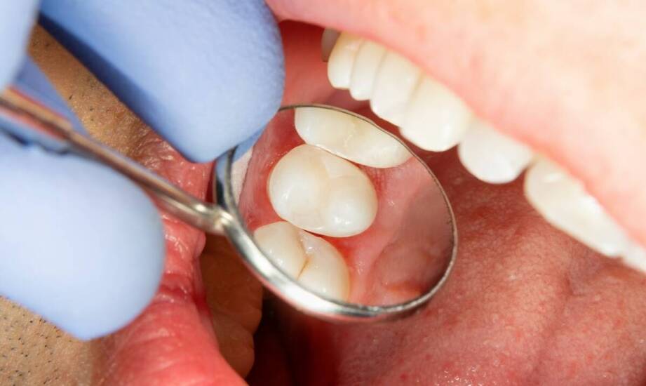 Leczenie kanałowe zębów – przebieg, wskazania i najważniejsze informacje