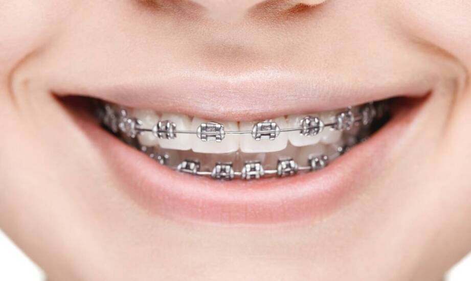 Wpływ aparatu ortodontycznego na poprawę funkcji zgryzu i mowy