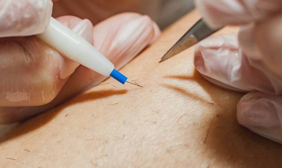 Mezoterapia igłowa Dr Cyj – efekty, wskazania i najważniejsze informacje