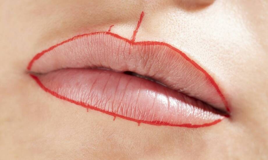 Wypełniacze do ust – wszystko, co warto wiedzieć przed zabiegiem