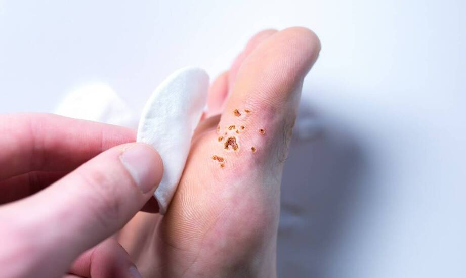 Jak skutecznie ograniczyć populację pcheł – praktyczne wskazówki i fakty