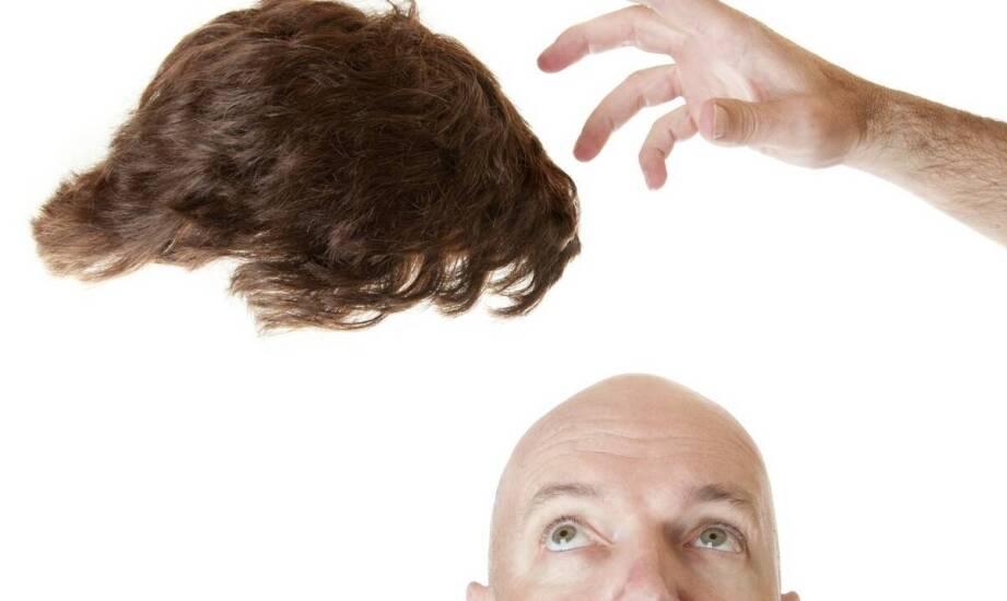 Najważniejsze informacje o zabiegu przeszczepu włosów – wskazania i efekty