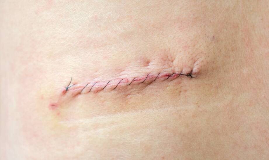 Nowoczesne metody leczenia żylaków – skuteczne rozwiązania i rezultaty