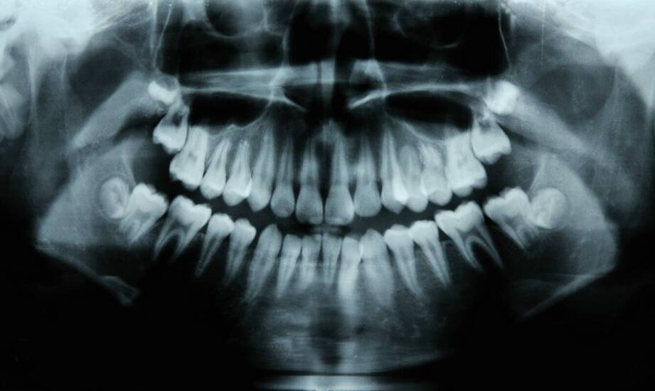 Tomografia komputerowa zębów – jak przygotować się do badania i co wykrywa