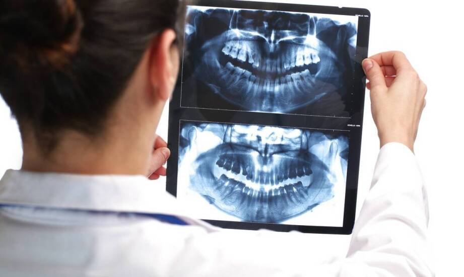 Tomografia komputerowa zębów – jak wpływa na leczenie stomatologiczne