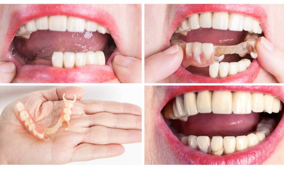 Jak przebiega proces wykonania protezy zębowej i co warto wiedzieć przed decyzją