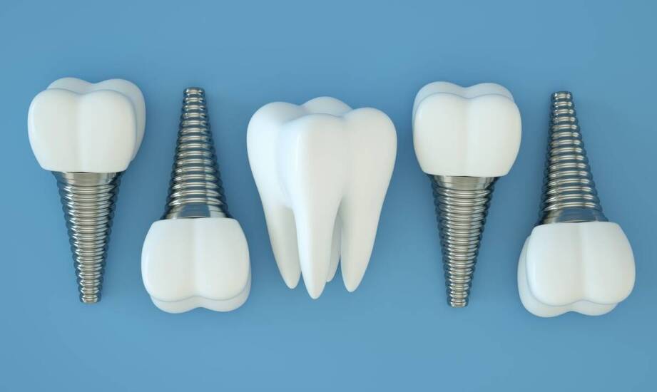 Implanty zębów – etapy leczenia oraz najważniejsze korzyści dla pacjentów