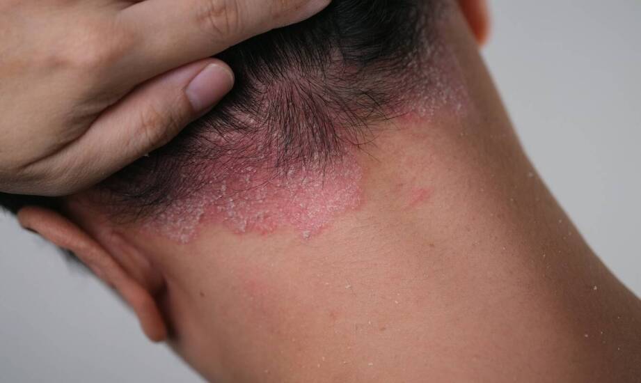 Grzybica skóry głowy – jak rozpoznać objawy i jak przebiega leczenie