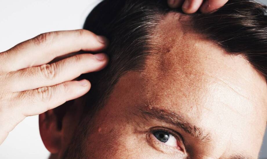 Łysienie plackowate – najnowsze metody leczenia i wsparcie trychologa