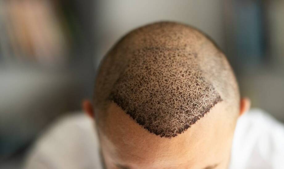 Jak wygląda zabieg przeszczepu włosów oraz na co zwrócić uwagę przed decyzją