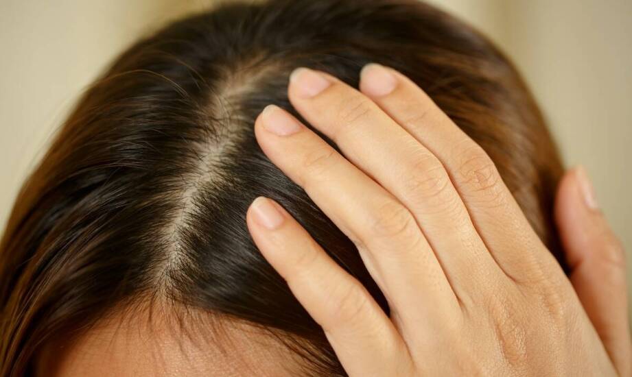 Skuteczne sposoby na swędzenie skóry głowy oraz najczęstsze przyczyny