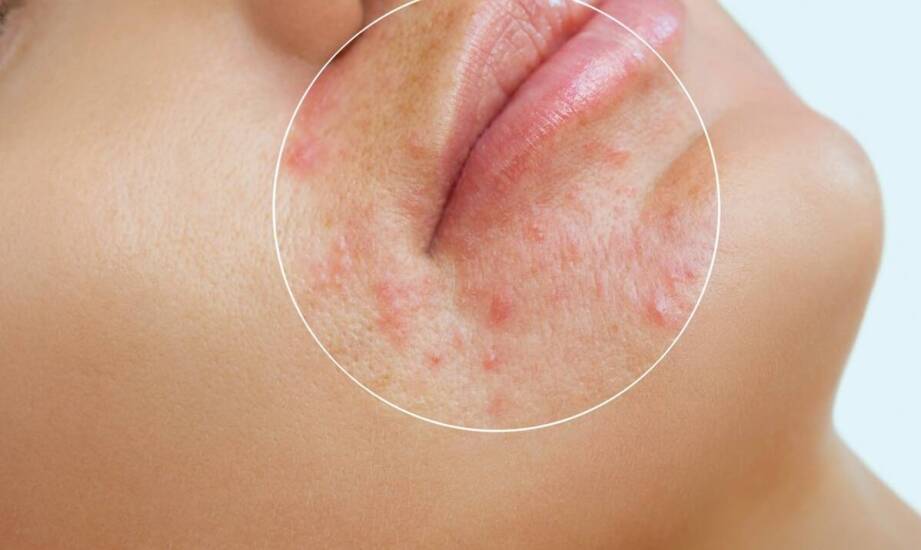 Atopowe zapalenie skóry – sprawdzone sposoby łagodzenia objawów i pielęgnacji