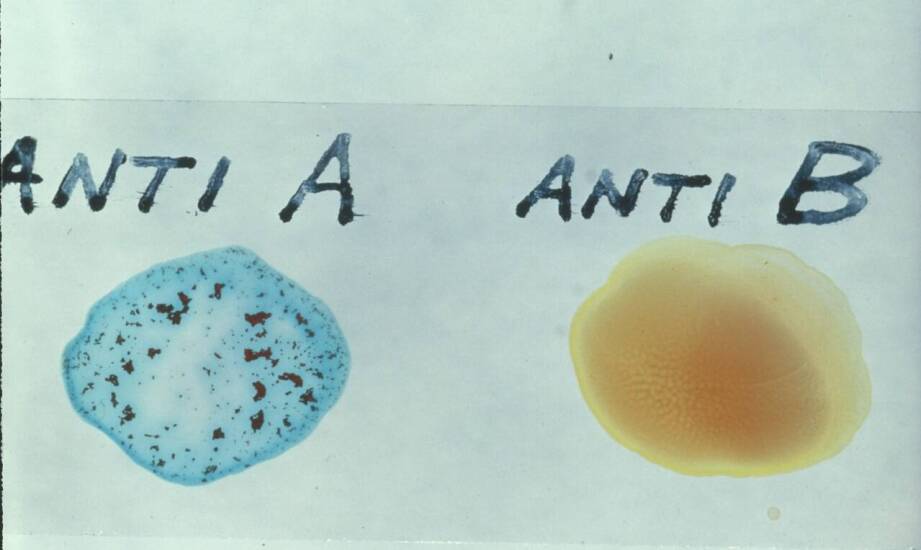 Bezocze – czym jest ta wada wzroku, przyczyny i najważniejsze objawy