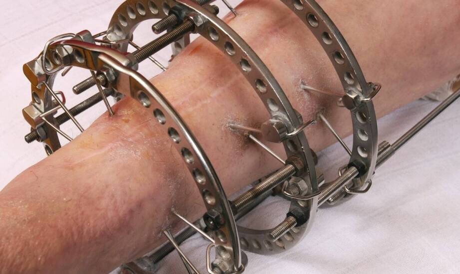 Protezowanie oczodołu – etapy, zastosowania i efekty leczenia okulistycznego