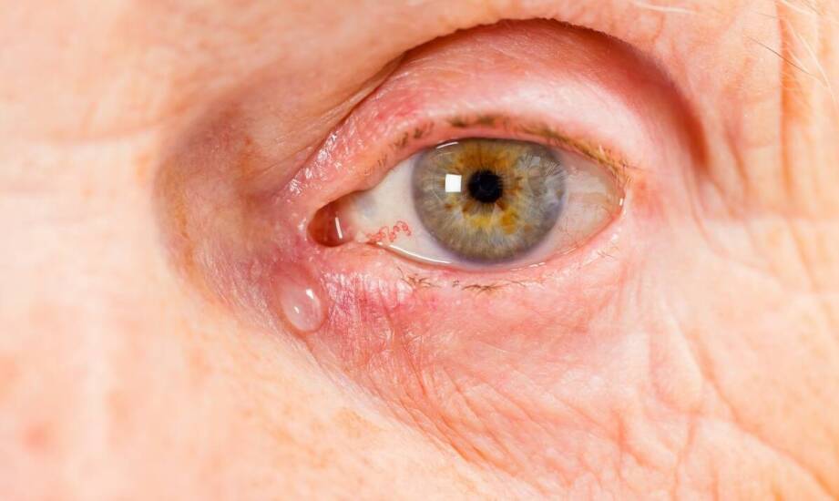 Czym są zatkane kanaliki łzowe? Objawy, przyczyny i możliwe sposoby leczenia