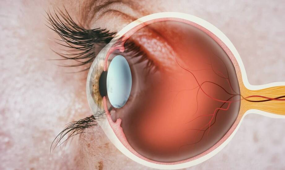 Zaćma wtórna – jak ją rozpoznać, jakie są przyczyny i możliwe skutki