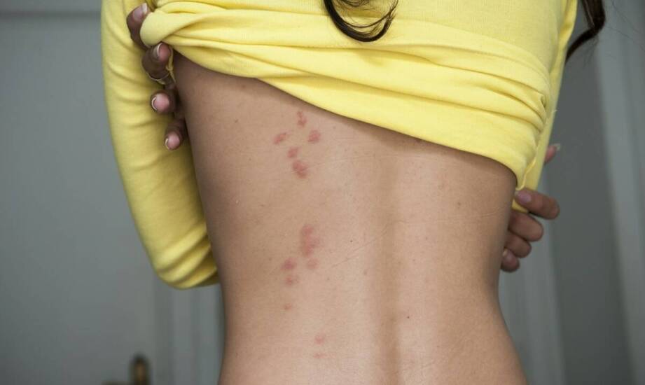 Warroza - jak ją zwalczać?