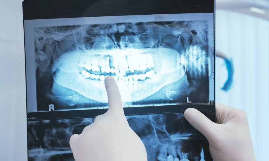 Rola RTG zębów w wykrywaniu próchnicy i chorób przyzębia