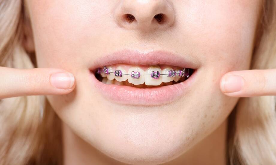 Czy korekta wad zgryzu zawsze wymaga noszenia aparatu?