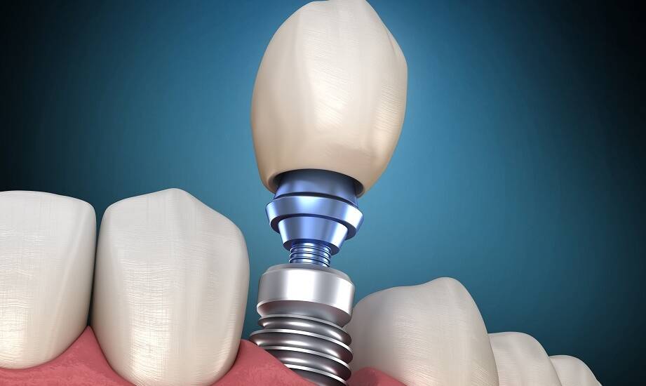 Zalety korzystania z nowoczesnych technologii w implantologii