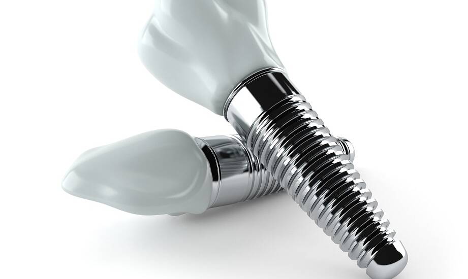 Dlaczego implanty zębowe są trwałym rozwiązaniem dla wielu pacjentów?