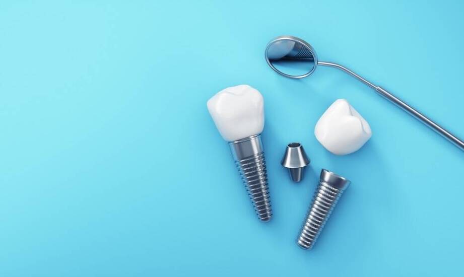 Jakie są najczęstsze pytania pacjentów dotyczące implantów? Odpowiada Dentysta Bochnia