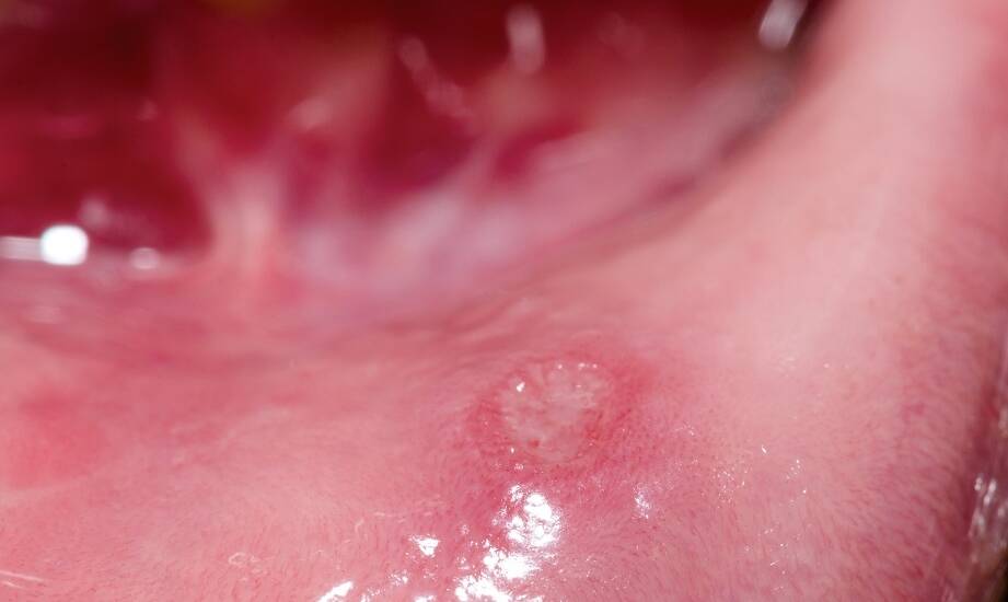 Torbiele w jamie ustnej: jak rozpoznać i leczyć problem chirurgicznie