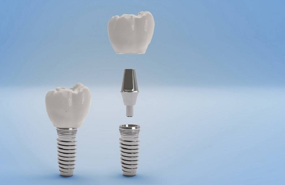 Implanty zębowe a inne metody uzupełniania braków zębowych